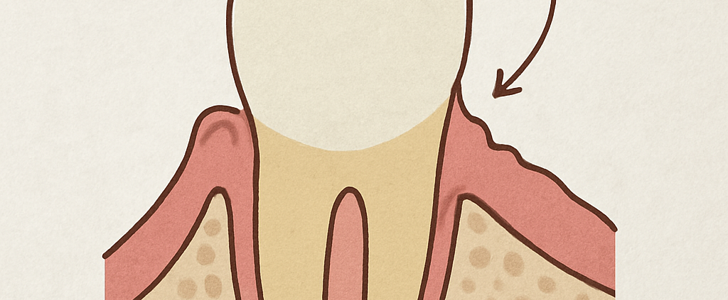 Gum recession diagram