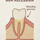 Gum recession diagram